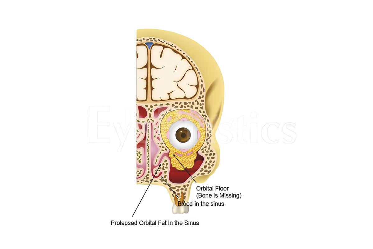 ORBITA (Skull Cavity of the Eye) BLOW-OUT FRACTURES, ORBITA (Skull Cavity of the Eye) BLOW-OUT FRACTURES