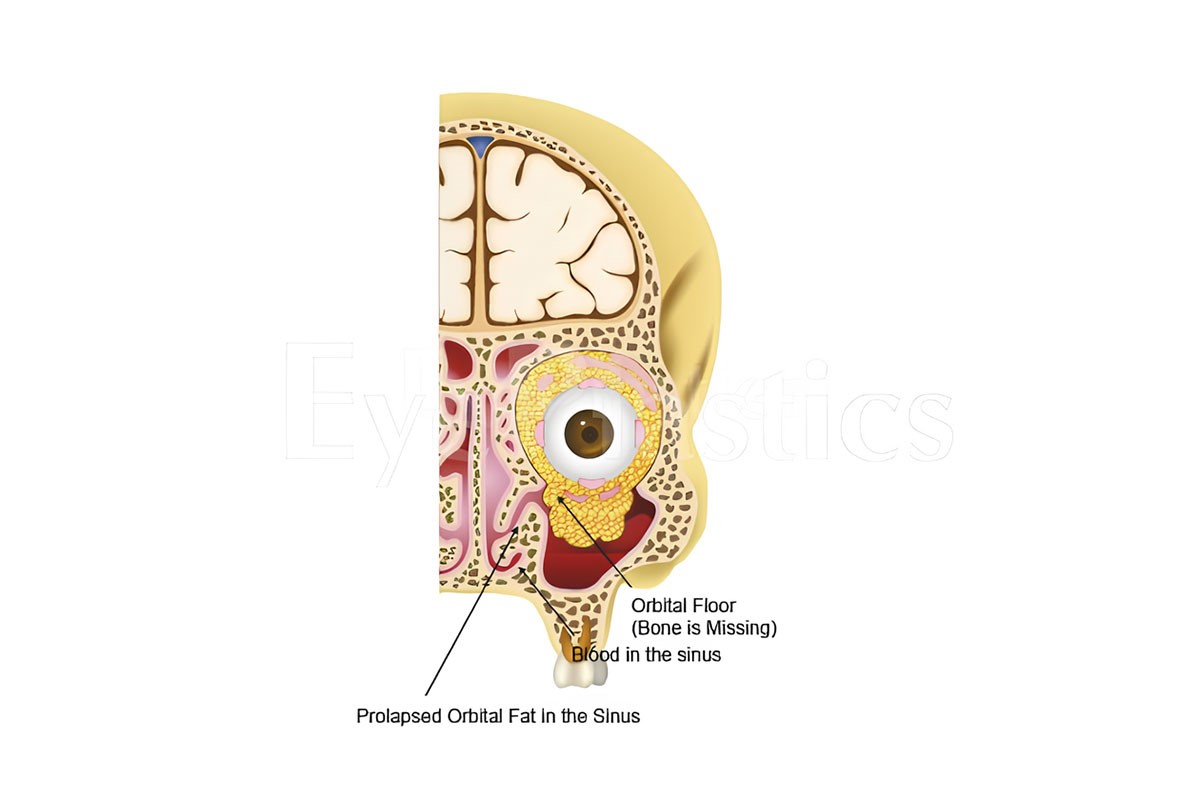 ORBITA (Skull Cavity of the Eye) BLOW-OUT FRACTURES