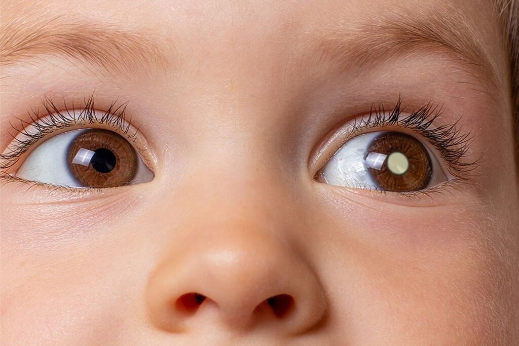 Retinoblastoma