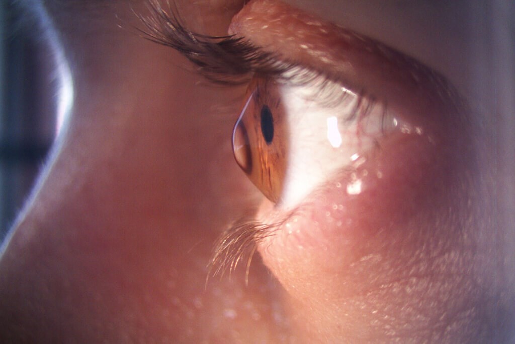 Keratoconus